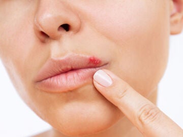 Una mujer con herpes labial