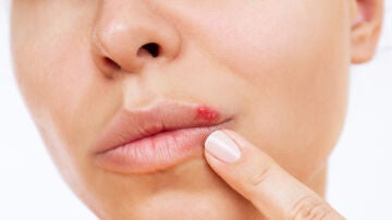 Una mujer con herpes labial