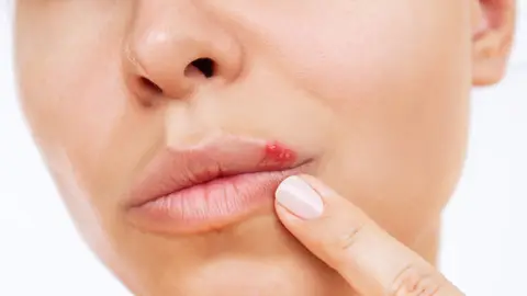 Una mujer con herpes labial Una mujer con herpes labial