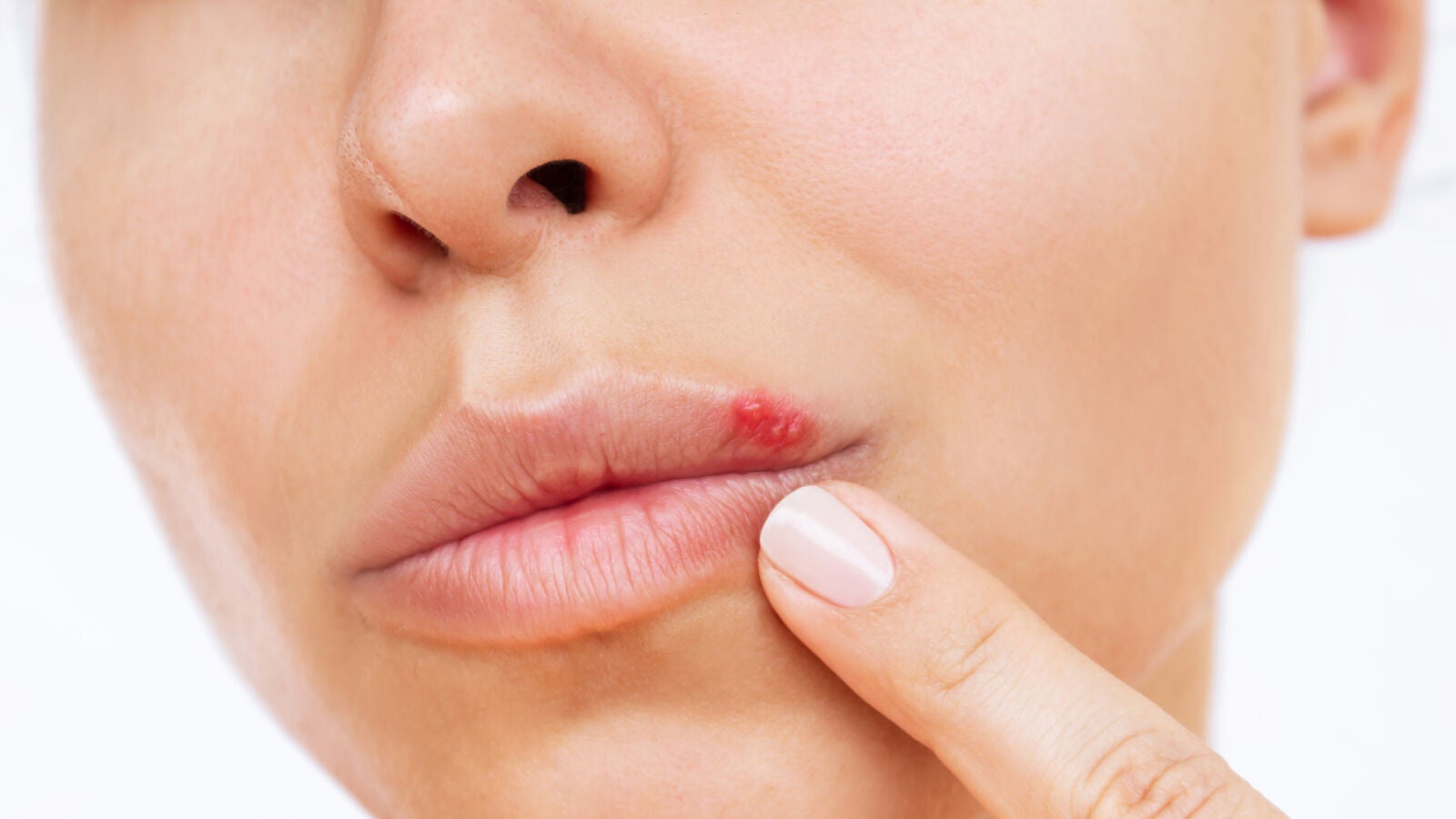¿Se puede tomar el sol con un herpes?