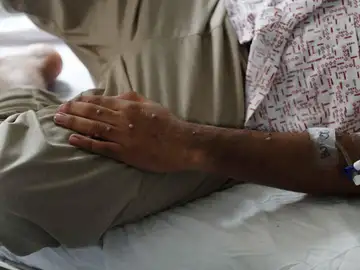 Imagen de archivo de un paciente tras ser diagnosticado con la viruela del mono. Imagen de archivo de un paciente tras ser diagnosticado con la viruela del mono.