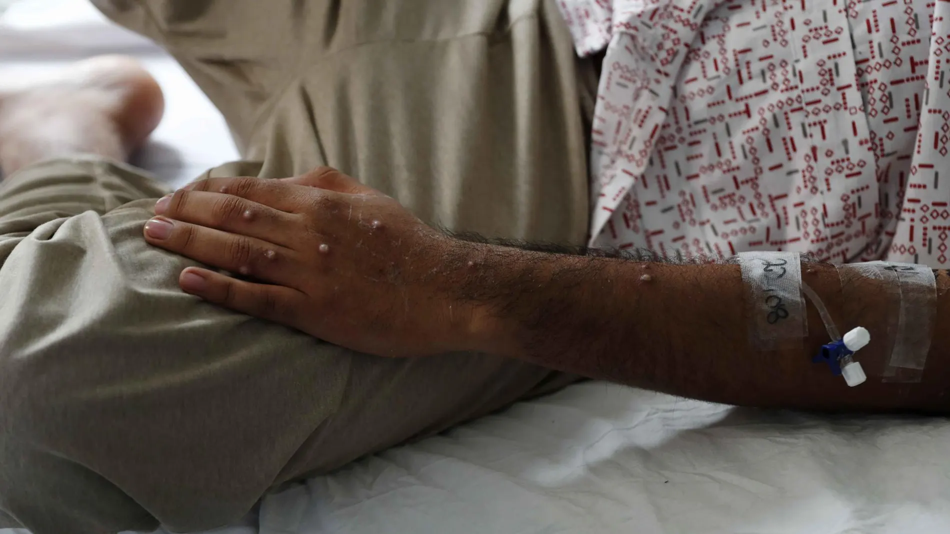 Imagen de archivo de un paciente tras ser diagnosticado con la viruela del mono. Imagen de archivo de un paciente tras ser diagnosticado con la viruela del mono.