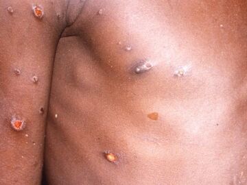 África registra un aumento "sin precedentes" en casos de mpox con brotes en 15 países