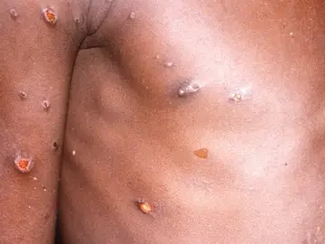 África registra un aumento "sin precedentes" en casos de mpox con brotes en 15 países África registra un aumento "sin precedentes" en casos de mpox con brotes en 15 países