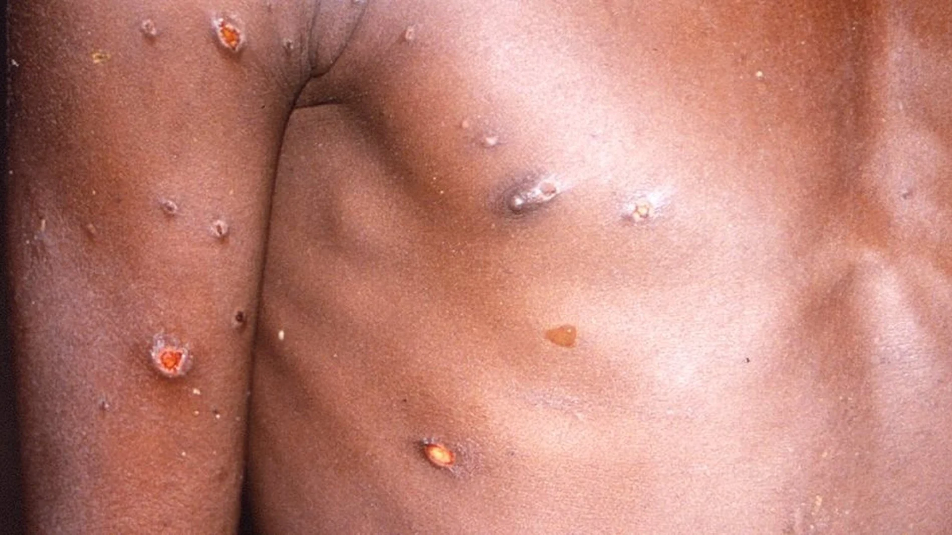 África registra un aumento "sin precedentes" en casos de mpox con brotes en 15 países África registra un aumento "sin precedentes" en casos de mpox con brotes en 15 países