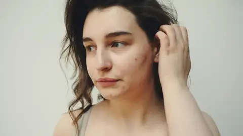 Un mujer con acné en el rostro Un mujer con acné en el rostro