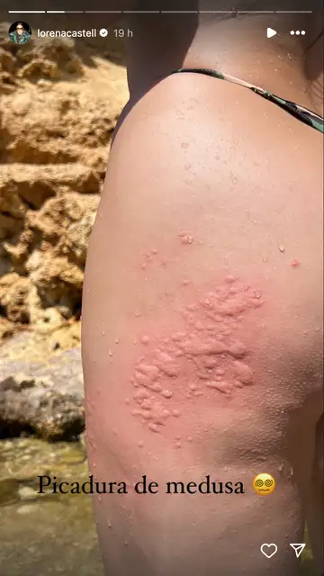 Lorena Castell enseña la picadura de medusa en Ibiza Lorena Castell enseña la picadura de medusa en Ibiza