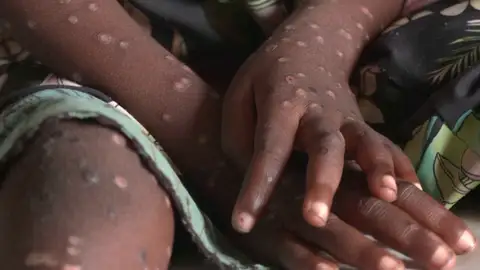 viruela del mono viruela del mono