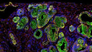 Inmunofluorescencia de un tumor de p&aacute;ncreas