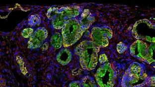 Inmunofluorescencia de un tumor de páncreas Inmunofluorescencia de un tumor de páncreas