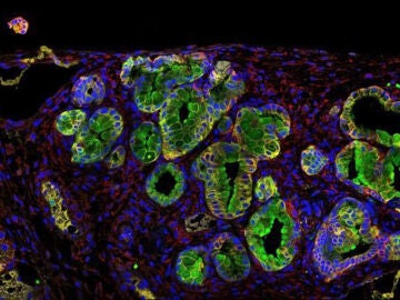 Inmunofluorescencia de un tumor de páncreas