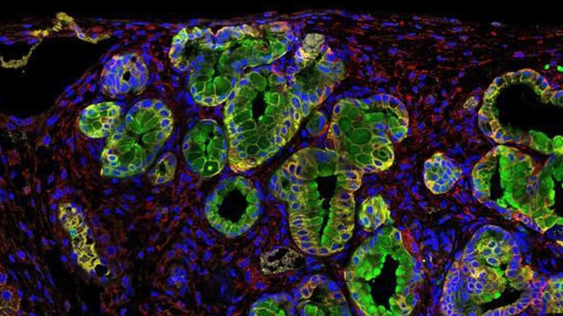 Inmunofluorescencia de un tumor de páncreas Inmunofluorescencia de un tumor de páncreas