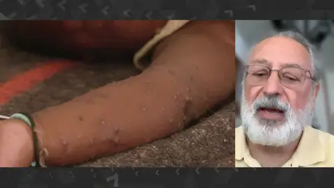 Declaraciones de Daniel López Acuña sobre la viruela del mono Declaraciones de Daniel López Acuña sobre la viruela del mono