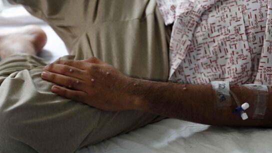 Un paciente es atendido tras ser diagnosticado con mpox
