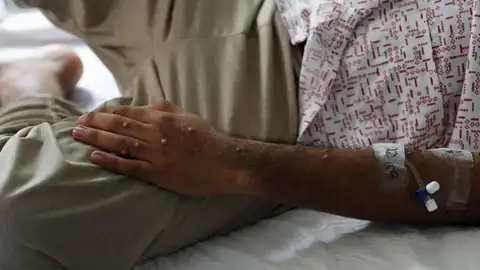 Un paciente es atendido tras ser diagnosticado con mpox Un paciente es atendido tras ser diagnosticado con mpox