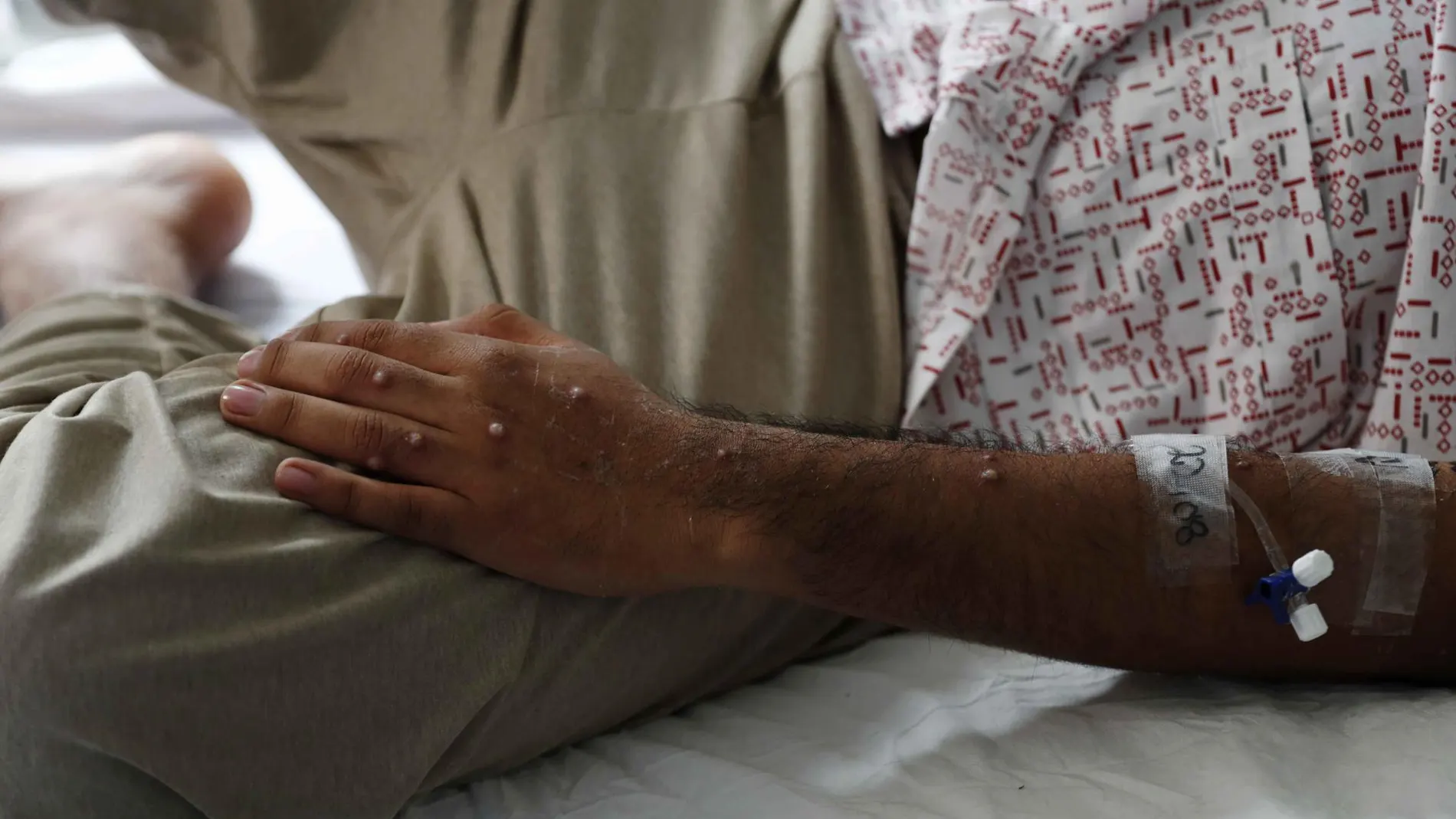 Un paciente es atendido tras ser diagnosticado con mpox Un paciente es atendido tras ser diagnosticado con mpox