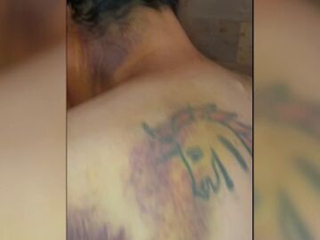 Javier, agredido en Urueña (Valladolid) por no llevar a su perro atado: "Me partió la muleta en la espalda"