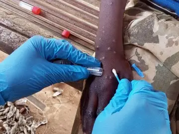 Heridas viruela del mono o mpox Heridas viruela del mono o mpox