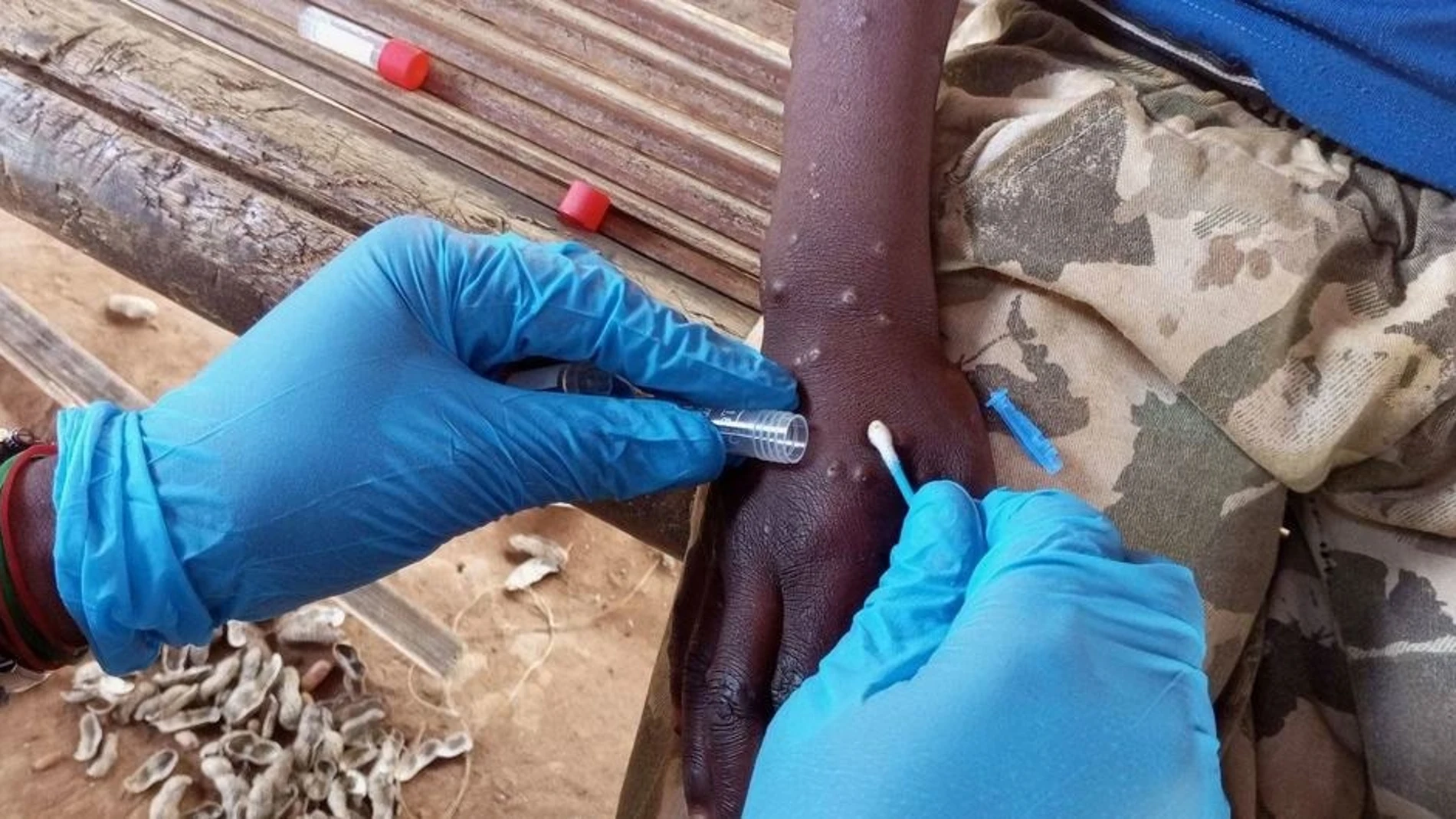 Heridas viruela del mono o mpox Heridas viruela del mono o mpox