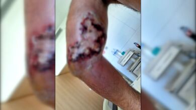 La vida de Duarte ha cambiado por completo tras la picadura de una araña violinista: 