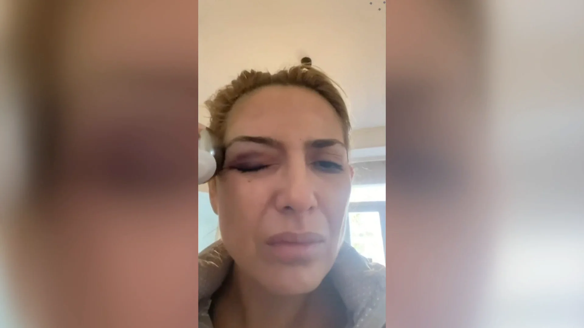 Fabiola Ya&ntilde;ez muestra sus lesiones