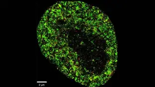 Imagen microscópica de una célula cancerosa Imagen microscópica de una célula cancerosa