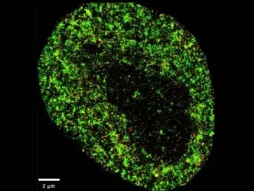 Imagen microscópica de una célula cancerosa Imagen microscópica de una célula cancerosa