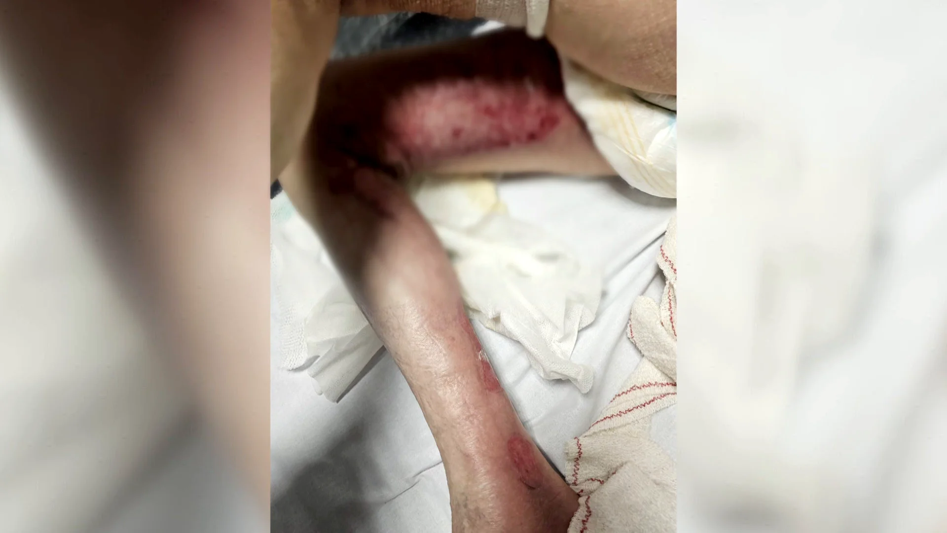 Una mujer de 71 años, abrasada con agua caliente en la residencia Una mujer de 71 años, abrasada con agua caliente en la residencia