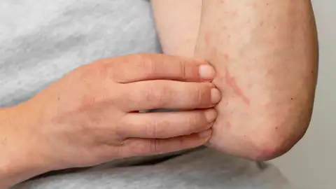 Dermatitis atópica Dermatitis atópica