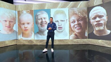 En España hay entre 3000 y 3500 albinos: ¿cómo es su vida?