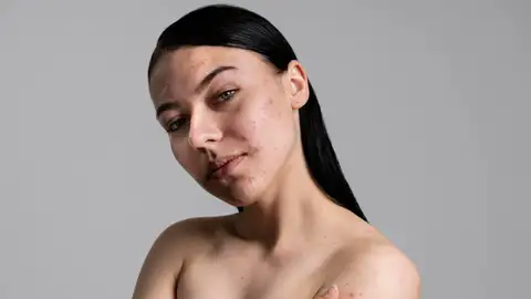 Chica con acné Chica con acné