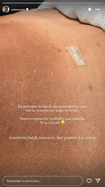 Virginia Troconis se somete a una biopsia por unas manchas en la piel Virginia Troconis se somete a una biopsia por unas manchas en la piel