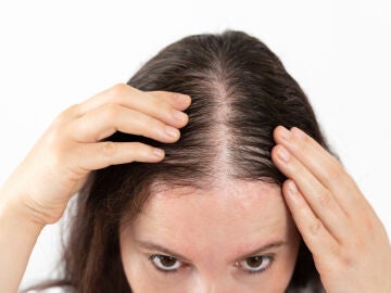 Una mujer con alopecia