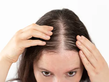 Una mujer con alopecia Una mujer con alopecia