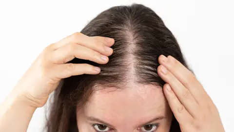 Una mujer con alopecia Una mujer con alopecia