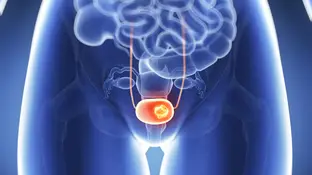 Cáncer de próstata Cáncer de próstata