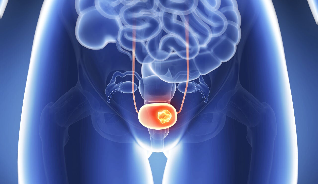 C&aacute;ncer de pr&oacute;stata