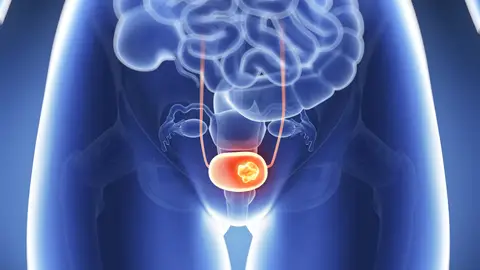 Cáncer de próstata Cáncer de próstata