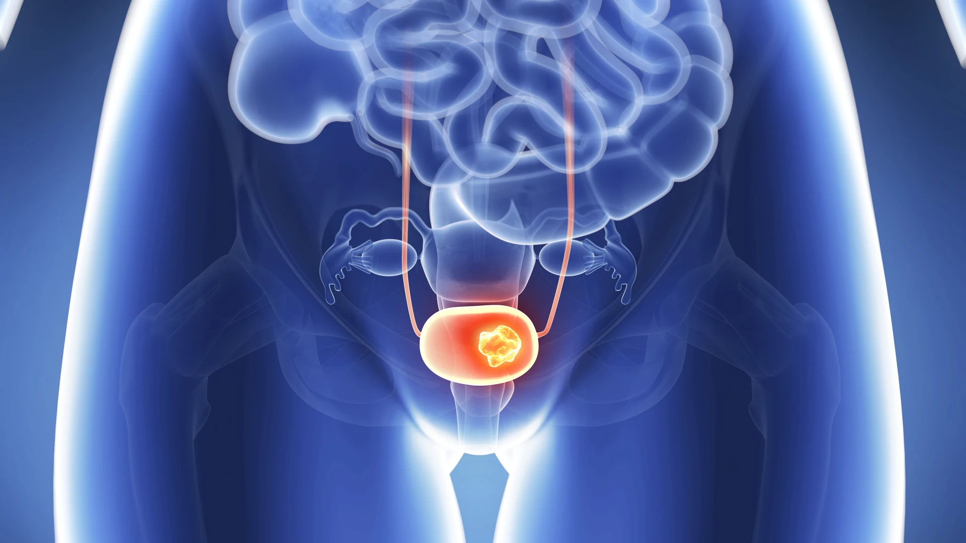 Cáncer de próstata Cáncer de próstata