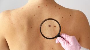 T&eacute;cnica pionera de medicina nuclear: dos pacientes libres de c&aacute;ncer de piel no melanoma
