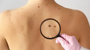 Técnica pionera de medicina nuclear: dos pacientes libres de cáncer de piel no melanoma Técnica pionera de medicina nuclear: dos pacientes libres de cáncer de piel no melanoma