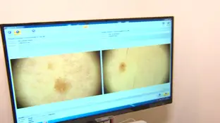Pruebas para detectar el cáncer de piel Pruebas para detectar el cáncer de piel