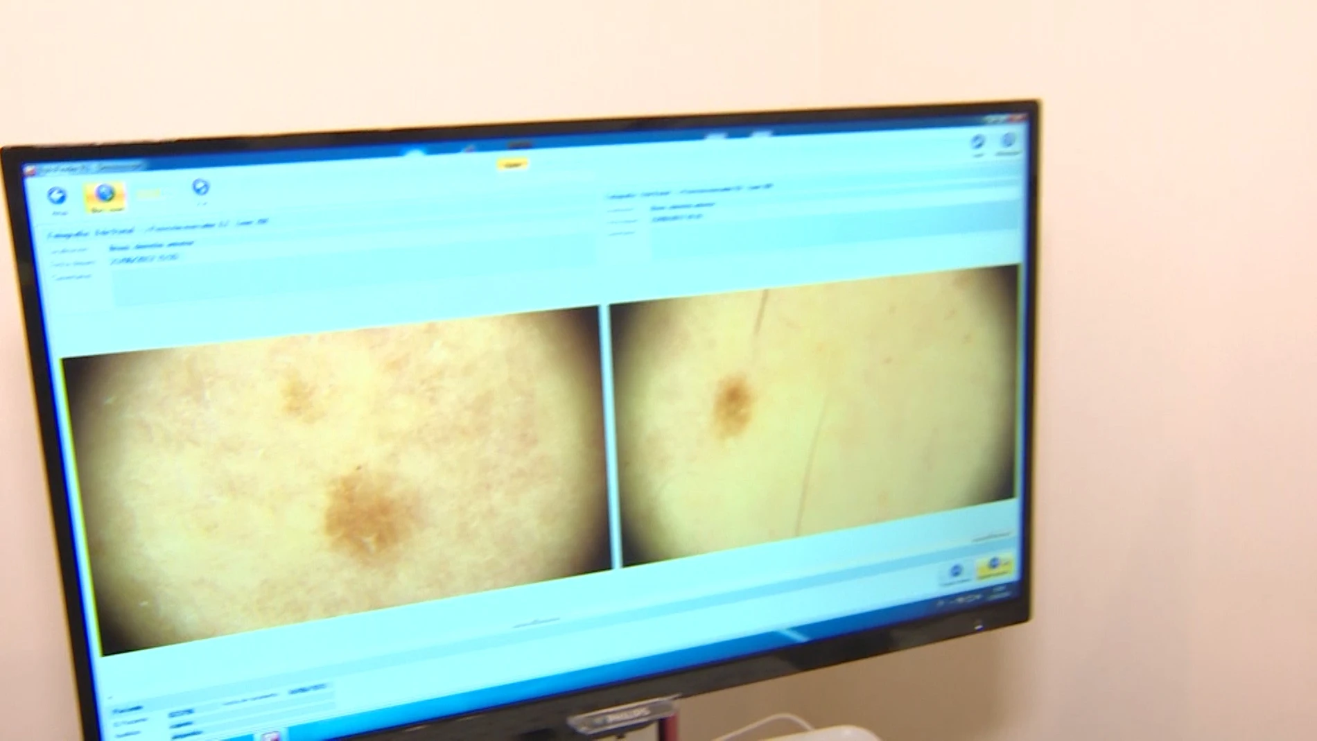 Pruebas para detectar el cáncer de piel Pruebas para detectar el cáncer de piel