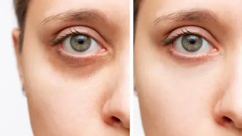 Diferencia de una ojera y otra Diferencia de una ojera y otra