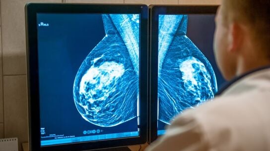 Las tasas de supervivencia a cinco a&ntilde;os del c&aacute;ncer de mama alcanzan ya el 86 %