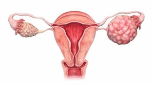 C&aacute;ncer de ovario