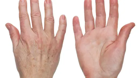 Unas manos con manchas Unas manos con manchas