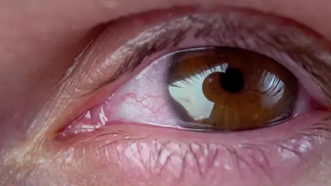 Ojos irritados Ojos irritados