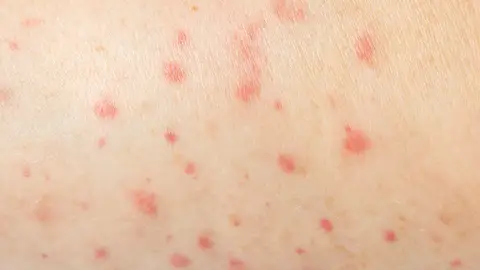 Acné corporal Acné corporal