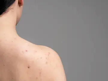 Granos en el cuerpo Granos en el cuerpo